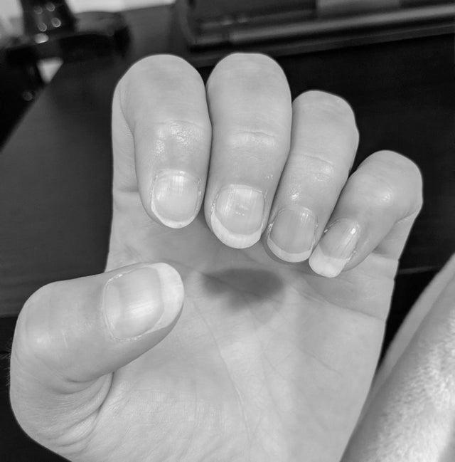 How to improve my nail health? image 1