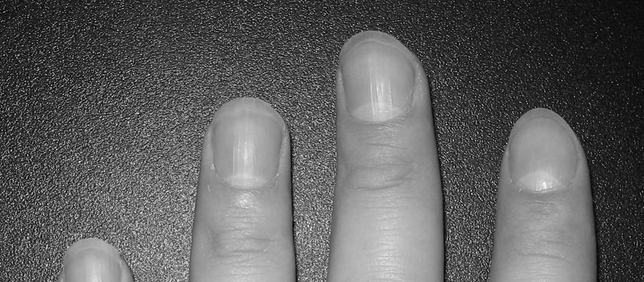 What are the small ridges in finger nails? image 1