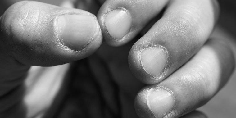What are the small ridges in finger nails? image 8