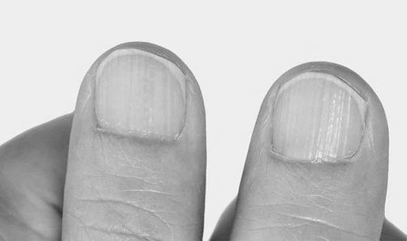 What vitamin are you lacking when your nails split? image 1