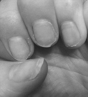 How do acrylic nails harm natural nails? image 12