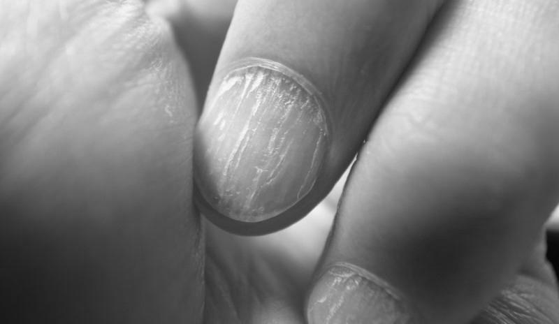 How can you cure brittle nails at home? image 11