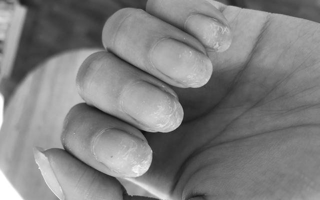 How does acetone damage your nails? image 0