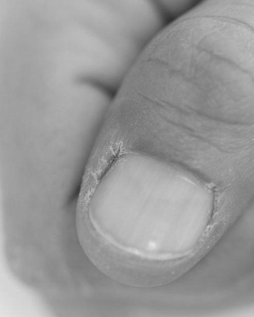 How does acetone damage your nails? image 3