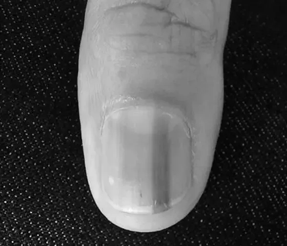 Why does a brown line appear on a fingernail? photo 2