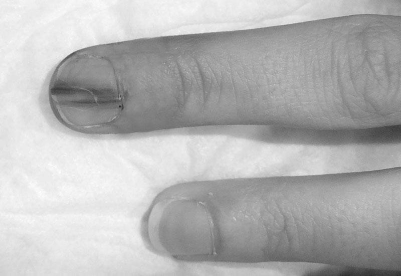 Why does a brown line appear on a fingernail? photo 4