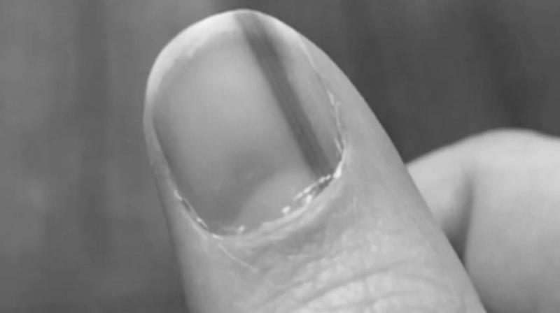 Why does a brown line appear on a fingernail? photo 6