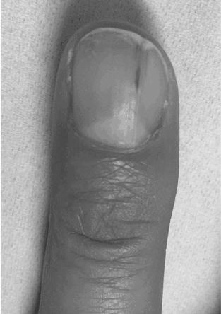Why does a brown line appear on a fingernail? photo 7