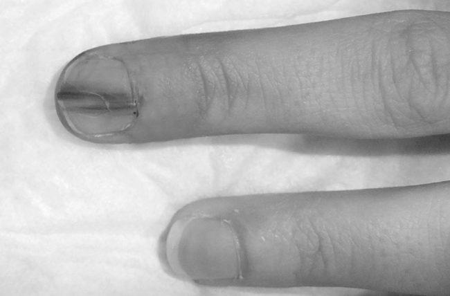 Why does a brown line appear on a fingernail? photo 10