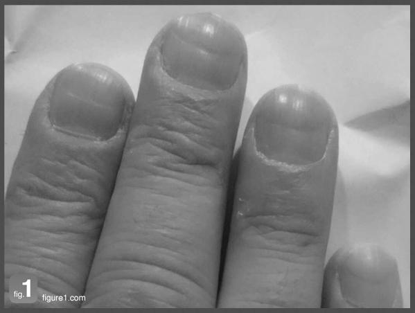 Why does a brown line appear on a fingernail? photo 11