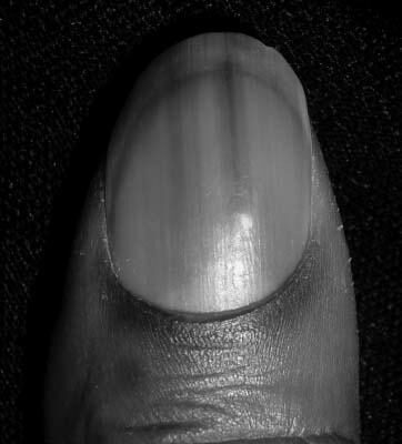 Why do I get dark lines in my fingernails? image 0