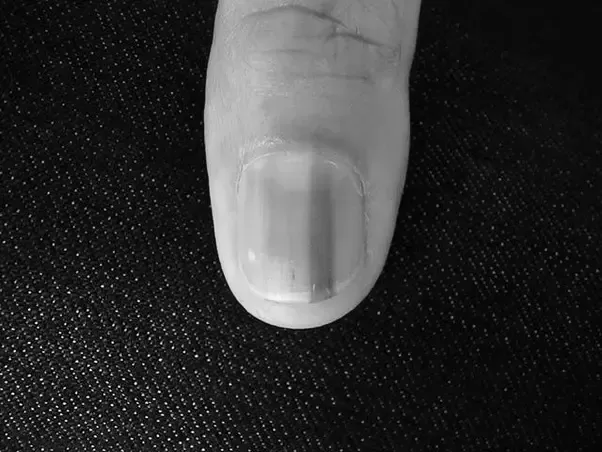 Why do I get dark lines in my fingernails? image 4