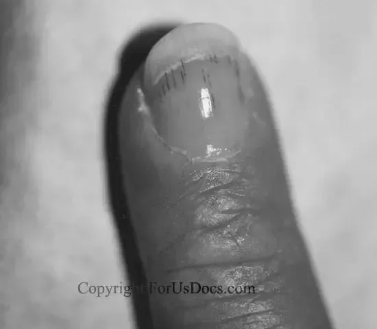Why do I get dark lines in my fingernails? image 11