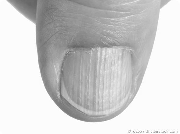 How do vertical lines on my fingernails form? image 2