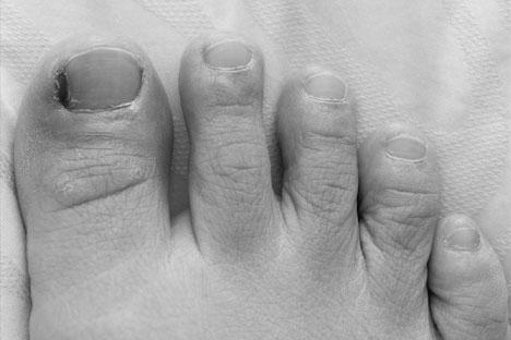 How do you remove a toenail without pain? photo 8