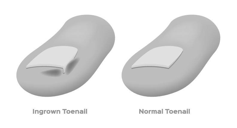 How do you remove a toenail without pain? photo 9