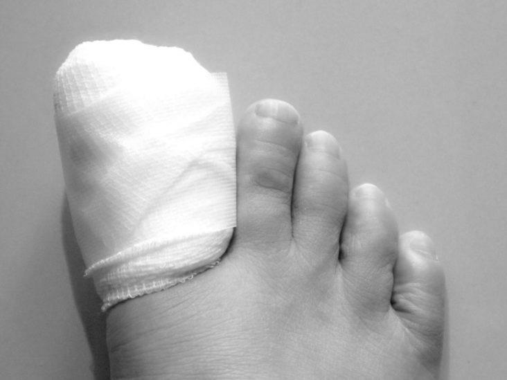 How do you remove a toenail without pain? photo 10