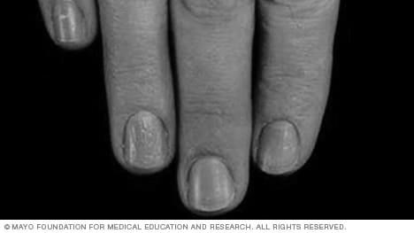 What causes purple fingernails? image 11