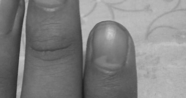 How can I get the lunulae back to my fingers? image 0