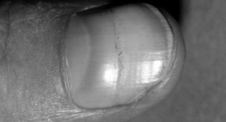 What causes nail growth? image 1