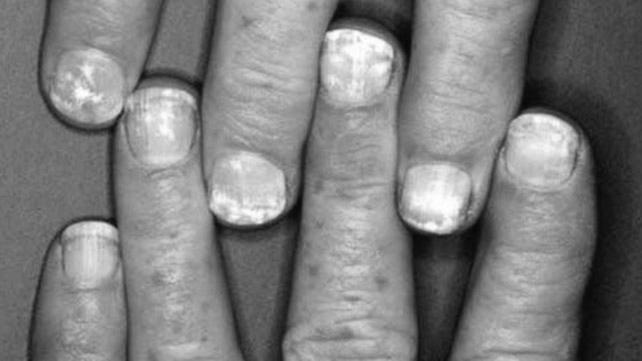 What causes nail growth? photo 0