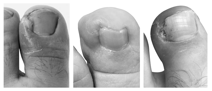 What is it like to have ingrown toenail surgery? photo 2