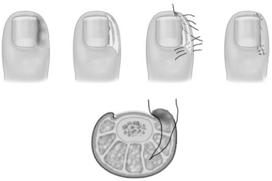 What is it like to have ingrown toenail surgery? photo 3