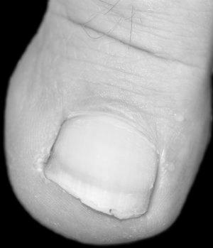 What is it like to have ingrown toenail surgery? photo 4