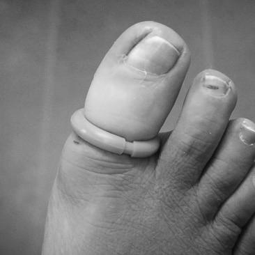 What is it like to have ingrown toenail surgery? photo 7