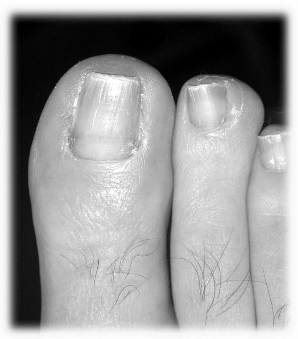 What is it like to have ingrown toenail surgery? photo 9