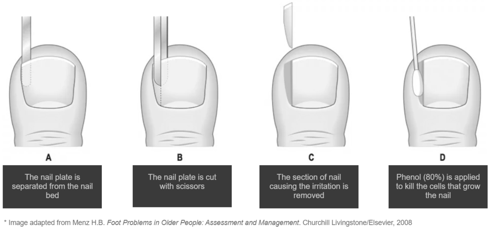 What is it like to have ingrown toenail surgery? photo 12