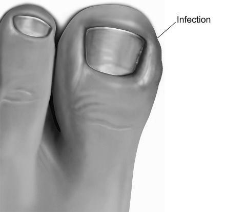 What is it like to have ingrown toenail surgery? photo 14