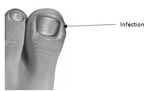 What is it like to have ingrown toenail surgery? photo 18