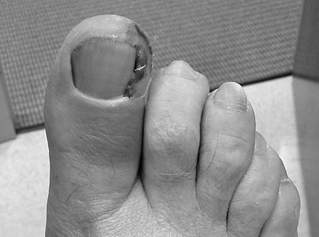 What is it like to have ingrown toenail surgery? image 0