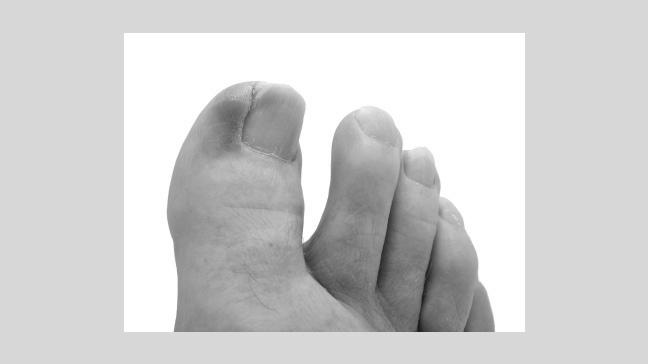 What are the major causes of ingrown toenails? photo 0