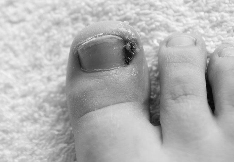 What are the major causes of ingrown toenails? photo 1