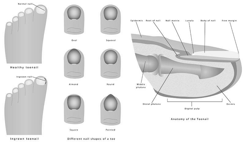 What are the major causes of ingrown toenails? photo 2