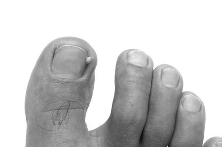 What are the major causes of ingrown toenails? photo 3