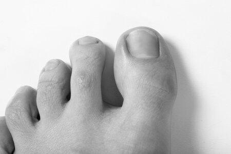 What are the major causes of ingrown toenails? photo 5