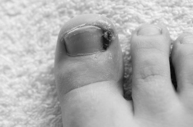 What are the major causes of ingrown toenails? photo 7