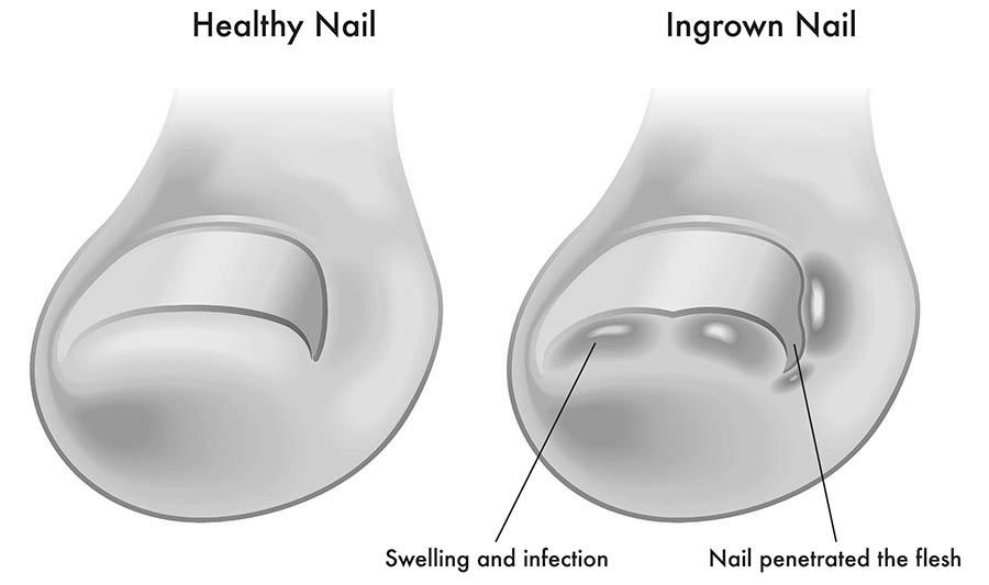What are the major causes of ingrown toenails? photo 11