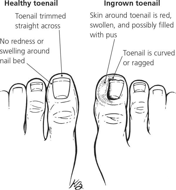 What are the major causes of ingrown toenails? photo 12