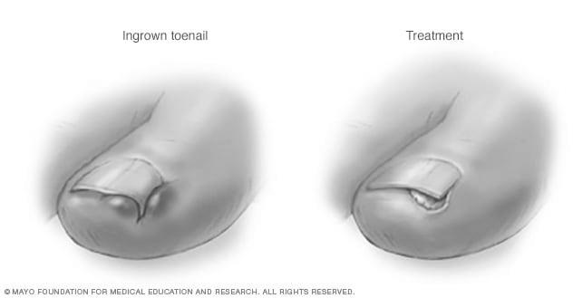 What are the major causes of ingrown toenails? photo 14