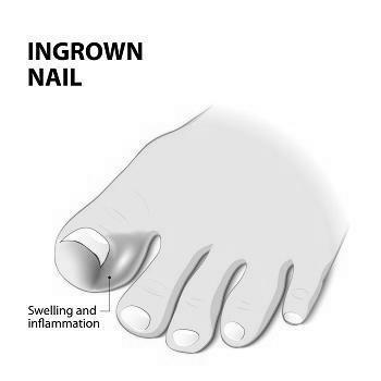 What are the major causes of ingrown toenails? photo 17