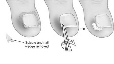 What are the major causes of ingrown toenails? photo 18