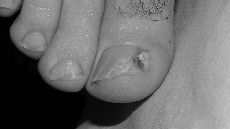 How can you treat smelly toenails? photo 8