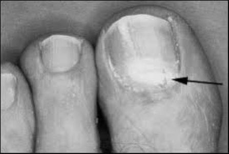 How can you treat smelly toenails? photo 9