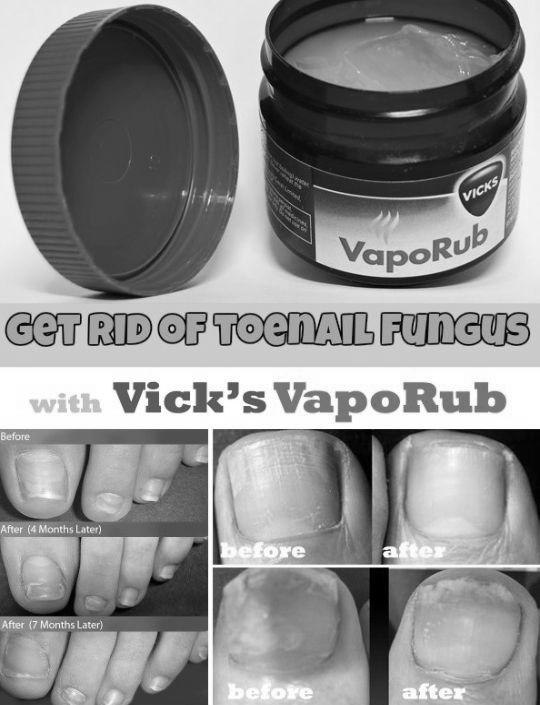 Does Vicks Vaporub really cure toenail fungus? photo 4
