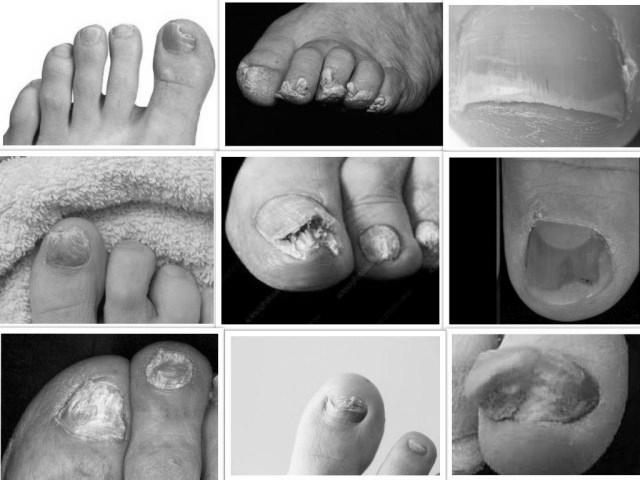 Does Vicks Vaporub really cure toenail fungus? photo 5