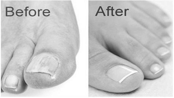 Does Vicks Vaporub really cure toenail fungus? photo 6
